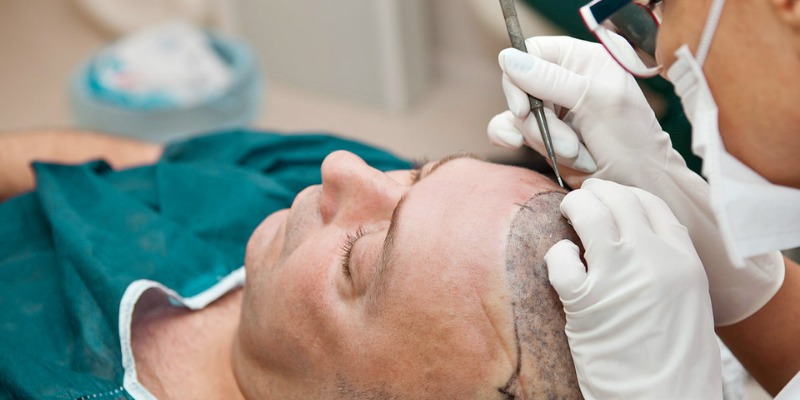 Sapphire Hair Clinic: Leading Experts in Hair Transplant Istanbul